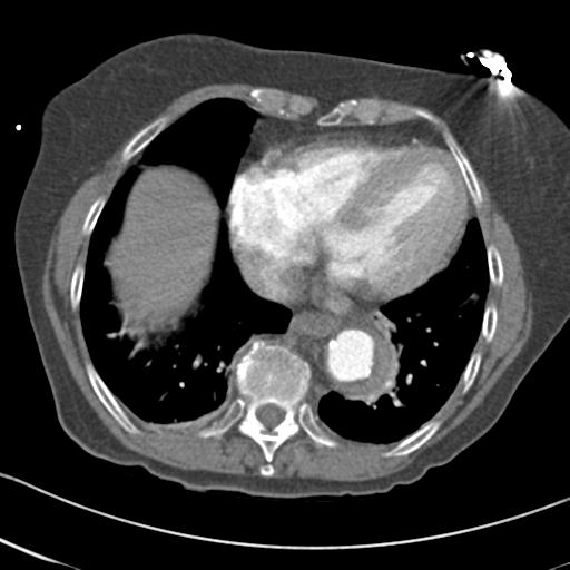 File:Aortic intramural hematoma from penetrating atherosclerotic ulcer (Radiopaedia 31137-31836 A 58).jpg