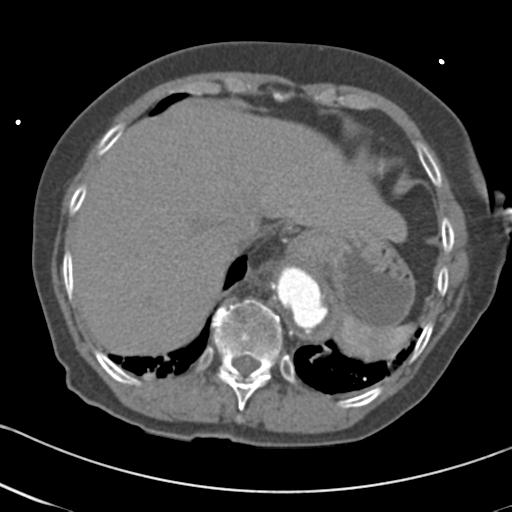 Aortic intramural hematoma from penetrating atherosclerotic ulcer (Radiopaedia 31137-31836 A 67).jpg