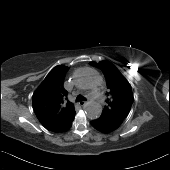 Aortic intramural hematoma with dissection and intramural blood pool (Radiopaedia 77373-89491 Axial non-contrast 34).jpg