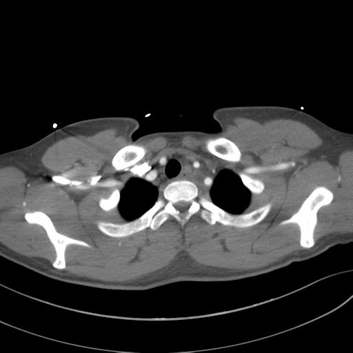 File:Aortic transection (Radiopaedia 29890-30405 A 16).jpg
