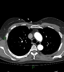 File:Aortic valve endocarditis (Radiopaedia 87209-103485 C 29).jpg