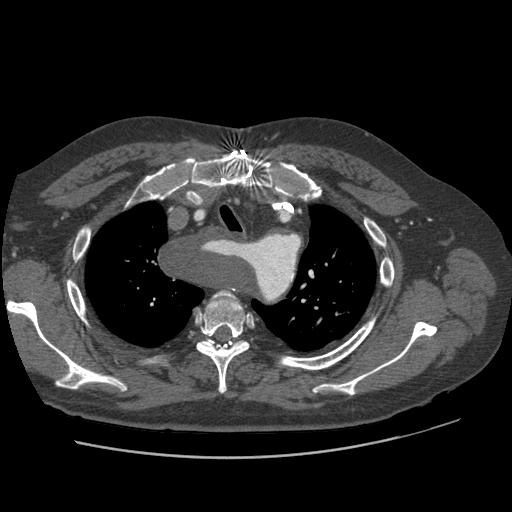 File:Aorto-coronary bypass graft aneurysms (Radiopaedia 40562-43157 A 27).png