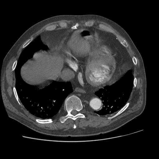 File:Aorto-coronary bypass graft aneurysms (Radiopaedia 40562-43157 A 95).png