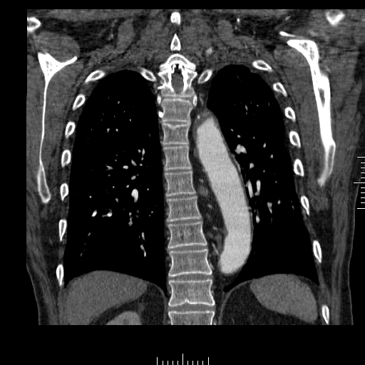 File:Aorto-coronary bypass graft aneurysms (Radiopaedia 40562-43157 B 34).png