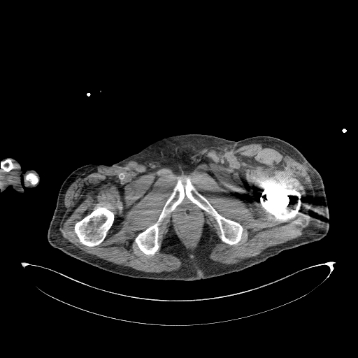 Aortoduodenal fistula (Radiopaedia 75286-86415 Axial non-contrast 81).jpg