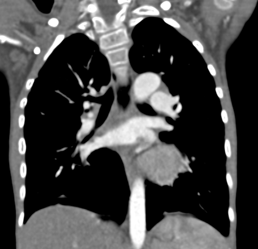 File:Aortopulmonary window, interrupted aortic arch and large PDA giving the descending aorta (Radiopaedia 35573-37074 D 42).jpg