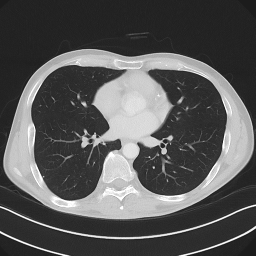 Apical pleural calcification (Radiopaedia 46141-50499 Axial lung window 40).png