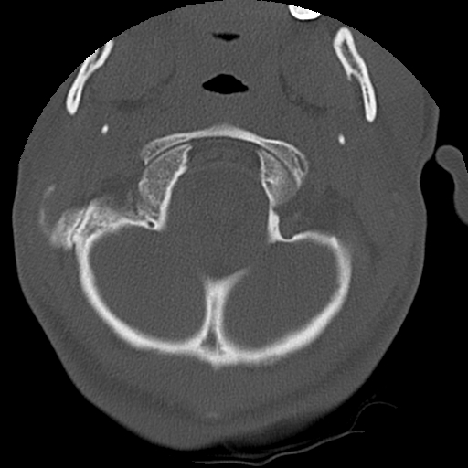 Apical pneumothorax on cervical spine CT (Radiopaedia 45343-49368 Axial bone window 8).jpg