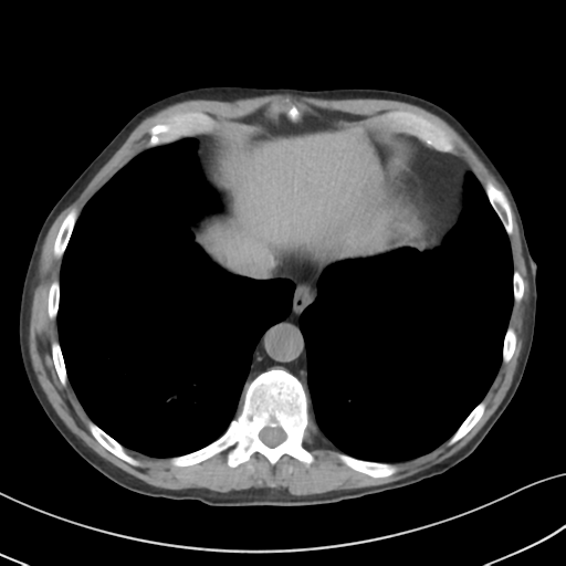 Apical pulmonary metastasis (Radiopaedia 46338-50754 B 51).png