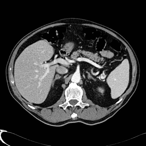 File:Appendiceal adenocarcinoma complicated by retroperitoneal abscess (Radiopaedia 58007-65039 B 42).jpg