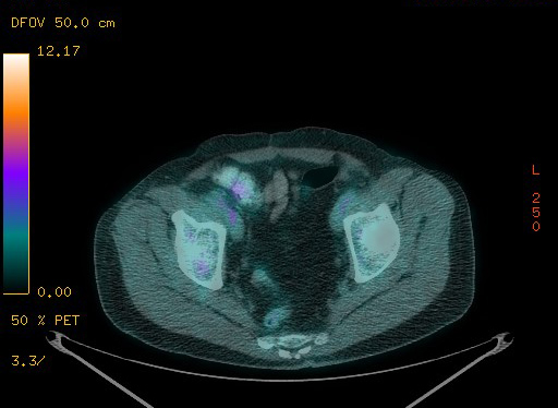 Appendiceal adenocarcinoma complicated by retroperitoneal abscess (Radiopaedia 58007-65041 Axial PET-CT 177).jpg