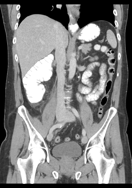 Appendicitis with thickening of the terminal ileum (Radiopaedia 42432-45550 B 32).png