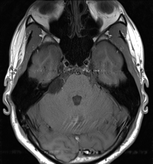 File:Arachnoid cyst - cerebellopontine angle (Radiopaedia 59689-67083 Axial T1 14).png
