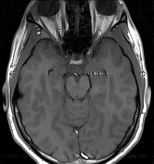 File:Arachnoid cyst - cerebellopontine angle (Radiopaedia 59689-67083 Axial T1 18).png