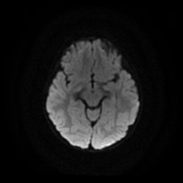 File:Arachnoid cyst - middle cranial fossa (Radiopaedia 86780-102938 Axial DWI 17).jpg