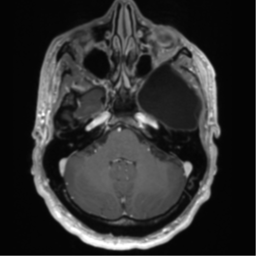Arachnoid cyst with subdural hematoma (Radiopaedia 85892-101743 Axial T1 C+ 23).png
