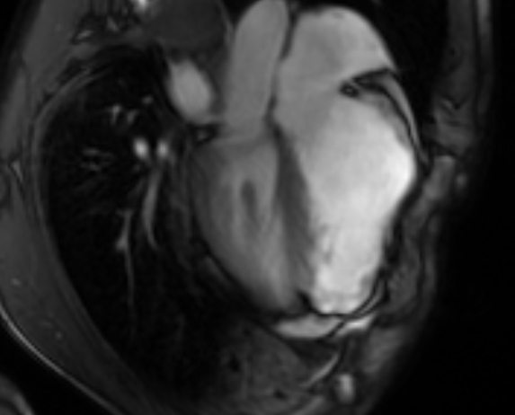 Arrhythmogenic right ventricular cardiomyopathy (Radiopaedia 69564-79464 4ch cine 87).jpg