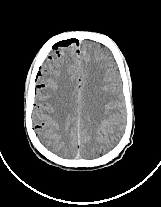 Arrow injury to the brain (Radiopaedia 72101-82607 Axial non-contrast 80).jpg