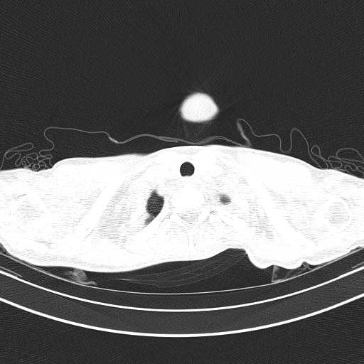 Arteria lusoria (Radiopaedia 88528-105192 Axial lung window 7).jpg