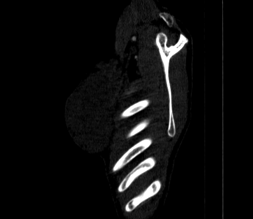 Arteria lusoria (Radiopaedia 88528-105192 C 15).jpg