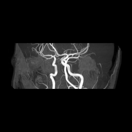 File:Artery of Percheron infarct (Radiopaedia 40966-43676 G 41).jpg
