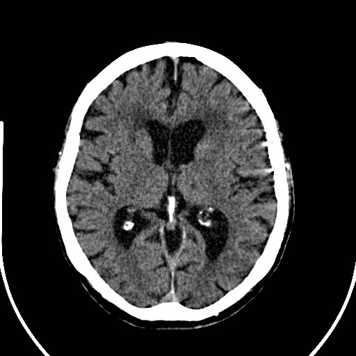 File:Artery of Percheron infarction (Radiopaedia 26307-26438 Axial non-contrast 22).jpg