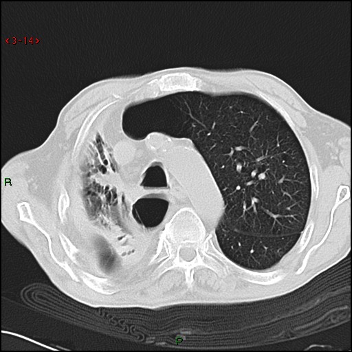 File:Aspergilloma (Radiopaedia 14842-14787 Axial lung window 14).jpg