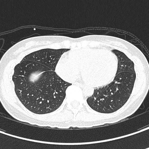 File:Aspergilloma (Radiopaedia 26223-26347 Axial lung window 55).jpg