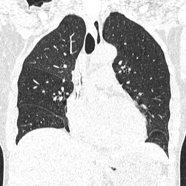 File:Aspergilloma (Radiopaedia 26223-26347 Coronal lung window 22).jpg