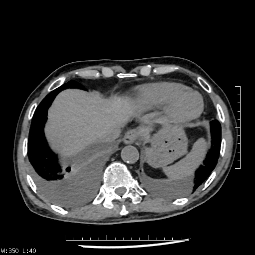 File:Aspergilloma (Radiopaedia 75184-86270 Axial liver window 36).jpg