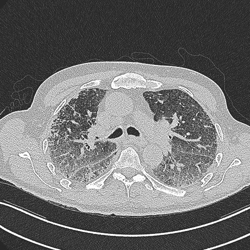 File:Aspergilloma on background pulmonary fibrosis (Radiopaedia 60942-68757 B 22).jpg
