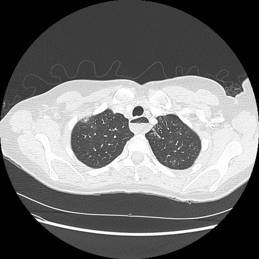 Aspiration pneumonia secondary to laparoscopic banding (Radiopaedia 18345-18183 lung window 14).jpg