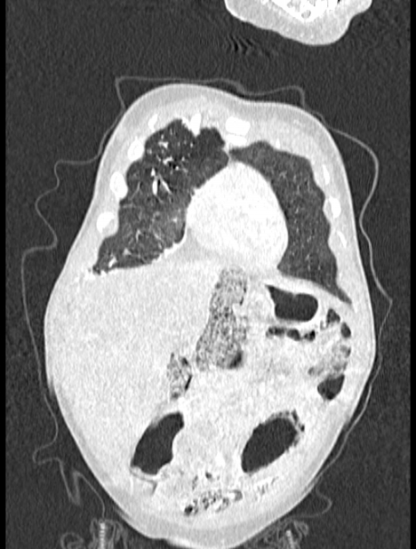 Asplenia syndrome (Radiopaedia 73083-83792 Coronal lung window 18).jpg