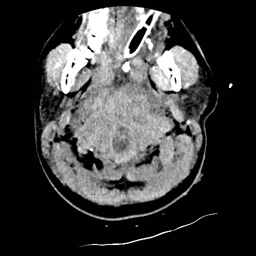 Atlanto-occipital dislocation (Radiopaedia 44648-48412 Axial non-contrast 2).jpg