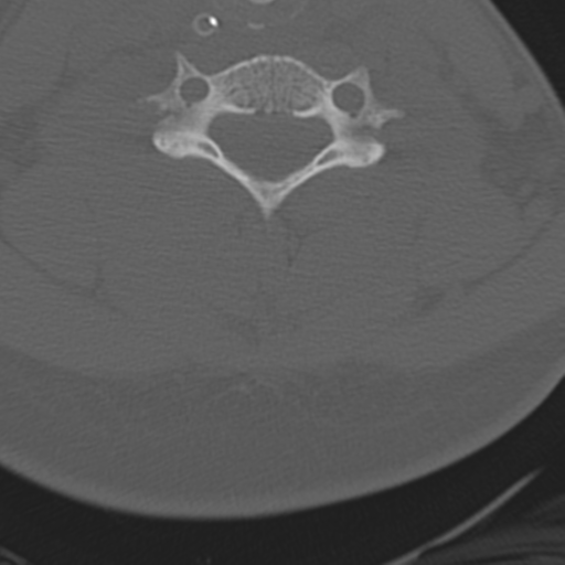 File:Atlanto-occipital dissociation (Radiopaedia 33848-35013 Axial bone window 34).png