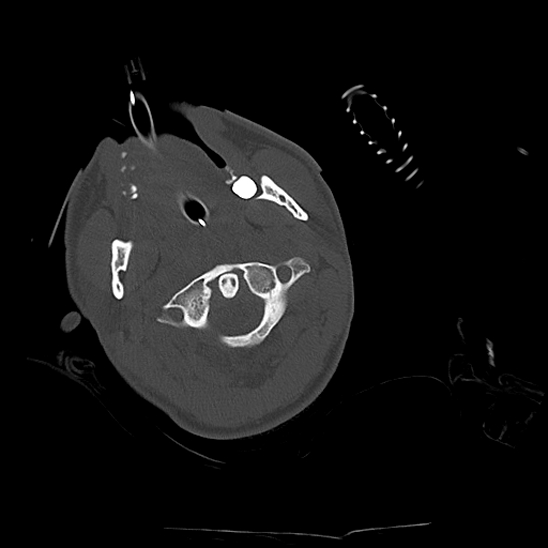 Atlanto-occipital dissociation (Traynelis type 1), C2 teardrop fracture, C6-7 facet joint dislocation (Radiopaedia 87655-104061 Axial bone window 22).jpg