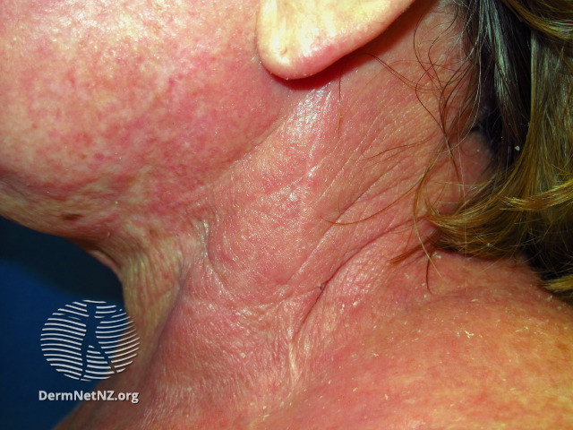 File:Atopic dermatitis affecting neck (DermNet NZ SCORAD-atopic-swollen-3).jpg