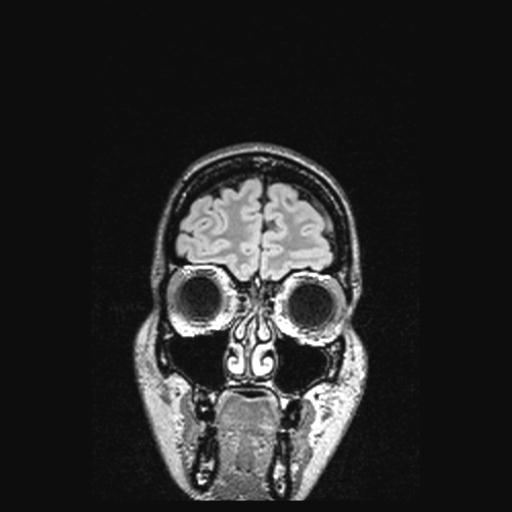 File:Atretic encephalocoele with inferior vermis hypoplasia (Radiopaedia 30443-31108 Coronal FLAIR 158).jpg