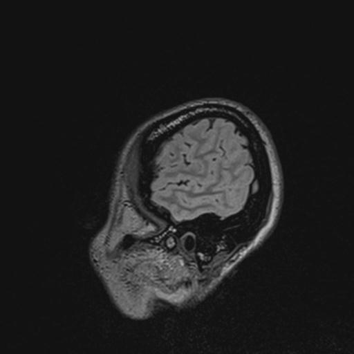 Atretic encephalocoele with inferior vermis hypoplasia (Radiopaedia 30443-31108 Sagittal FLAIR 136).jpg