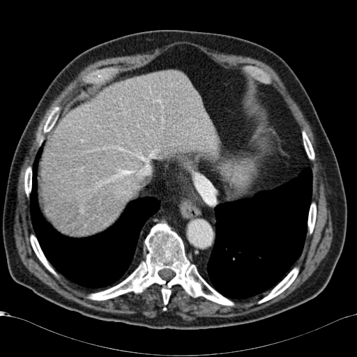 Atypical hepatocellular carcinoma (Radiopaedia 41744-44698 B 11).jpg