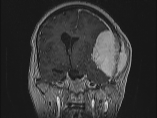 Atypical meningioma (Radiopaedia 62985-71406 Coronal T1 C+ 52).jpg