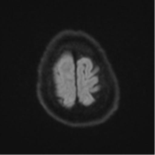 Atypical meningioma (WHO Grade II) (Radiopaedia 54742-60981 Axial DWI 53).png