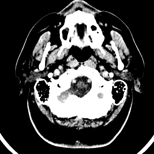 File:Atypical meningioma (WHO grade II) with brain invasion (Radiopaedia 57767-64728 Axial C+ 52).png