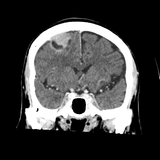 Atypical meningioma (WHO grade II) with osseous invasion (Radiopaedia 53654-59715 Coronal C+ delayed 25).png