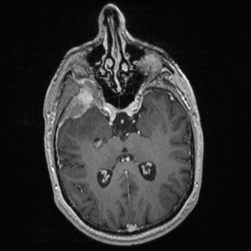 Atypical meningioma (grade II) - en plaque (Radiopaedia 29633-30147 Axial T1 C+ 87).jpg
