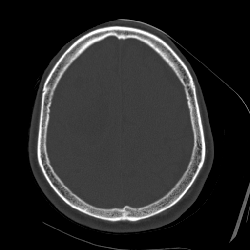 File:Atypical meningioma with skull invasion (Radiopaedia 34357-35649 Axial bone window 61).png