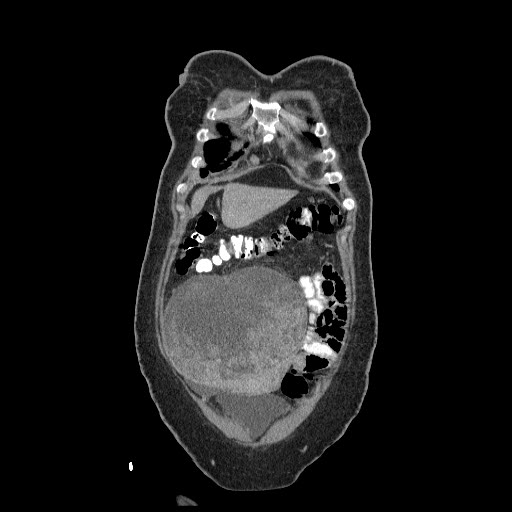 File:Atypical retroperitoneal lymphocoeles with large leiomyoma of uterus (Radiopaedia 32084-33024 B 2).jpg