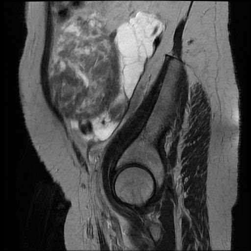 File:Atypical retroperitoneal lymphocoeles with large leiomyoma of uterus (Radiopaedia 32084-33027 Sagittal T2 4).jpg