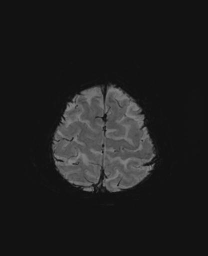Autoimmune limbic encephalitis (Radiopaedia 30363-31005 SWI - mIP 64).jpg