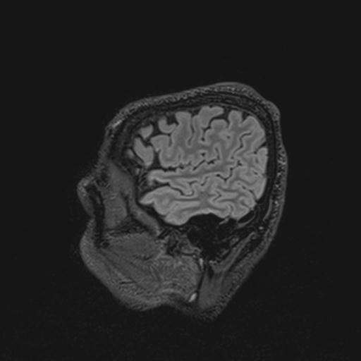 Autoimmune limbic encephalitis (Radiopaedia 30363-31005 Sagittal FLAIR 29).jpg